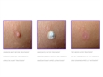 DISPOSITIVO CRIOCHIRURGICO CRYOMEGA con cartuccia 16 g